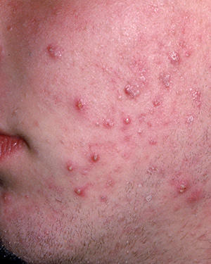 Study may explain why some people get pimples - Healthcanal.com